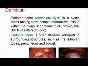 Surgical treatment of endometrioma