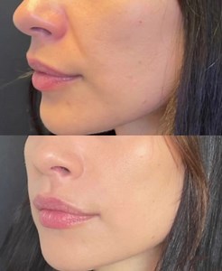 Nasolabial Fold Fillers Before & Right After  ⠀  Smile line...