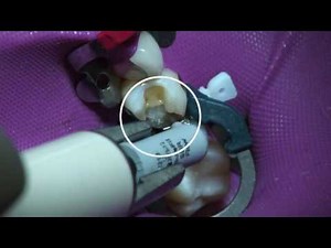 Palodent Plus Class II restoration