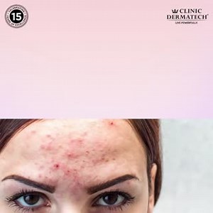 Forehead acne often looks like solid red bumps, called papules. You might also see bumps with a collection of pus at the top. These are called pustules. No matter where you spot acne, treat it properly and avoid picking at it to prevent scarring. Here at CD, we believe not all skin types are the same and personalize each treatment for different individuals. Be it Acne Control Peels, Carbon Miracle Facial, Photofacial IPL or A Personalised Dermatologist Consult - there’s something for everyone! H