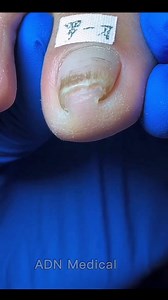 419K views · 3K reactions | Gentle Toenail Trim | Relaxing Spa Care #fypシ #toenailtrim #ToeCare #pedicure #SatisfyingCare | ADN Medical | Facebook