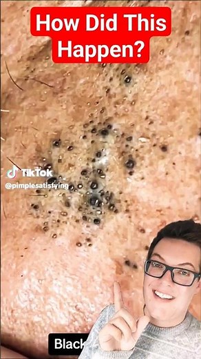 Insane BLACKHEAD REMOVAL - Extreme Edition #shorts