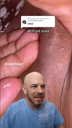 Hopefully this is an armpit… cyst popping #dermreacts #doctorreacts #ingrownhair #satisfying