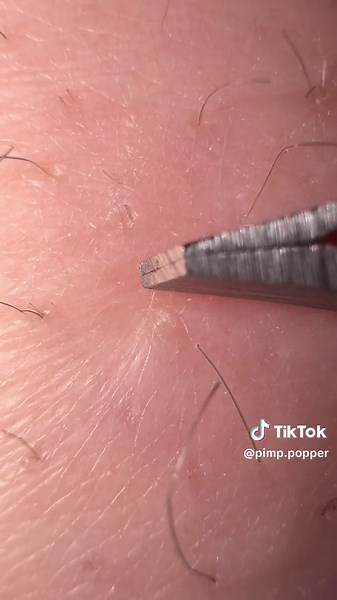 AMAZING INGROWN HAIR REMOVAL DEEP AND SATISFYING #ingrownhair #ingrown #tweezers #tweezer #tweezing #hair #ingrowns #pimple #pop #scabremoval #scab #satisfying #fyp #chupapimuñaño