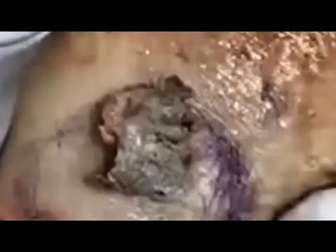 Adam's Comedone & Covid Recap! Cysts, Dilated Pores and Blackheads