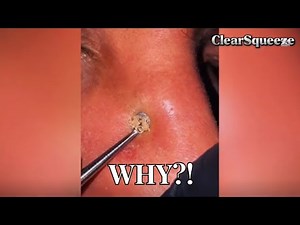 Pimple Popping and Blackhead Mistakes You Don't Know