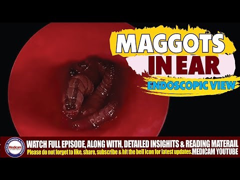 Maggots Myiasis Infestation in the Ear | Symptoms, Causes, Treatment, and Removal of Ear Maggots