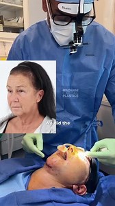 Immediately after a Facelift, Necklift, Blepharoplasty and Facial Fat Transfer (GRAPHIC)