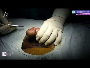 ZSR Stapler Circumcision Surgery | Frenuloplasty | Parley Penile Papule (PPP) | Dr. Jayanta Bain