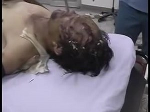 Gross! Aftermath of dead man with maggots eating his head