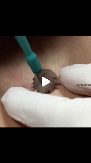 Sandra Lee, MD, FAAD, FAACS on Instagram: "For the serious popaholics - what is this tool called? Extra points if you can tell me what size it is too!⁠ ⁠ #drpimplepopper #popaholics"