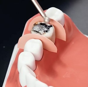 145K views · 508 reactions | Rotten Tooth Restoration Revealed! | Wood Mood | Facebook