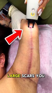 287K views · 1.3K reactions | Erase Scars with Breakthrough Laser...