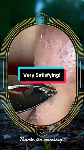 SqueezeUK popping acne pimple Satisfying abcess blackhead Removal viral #blackheads #pimplepop #skincare #acne #pimple