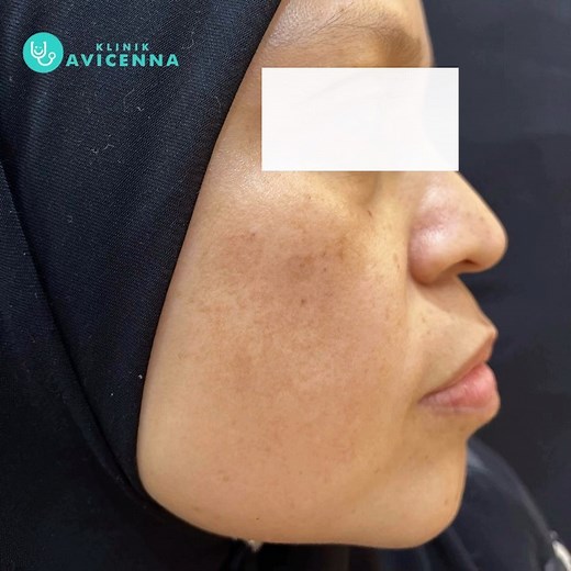 MELASMA atau dikenali lazimnya sebagai JERAGAT Melasma merupakan...