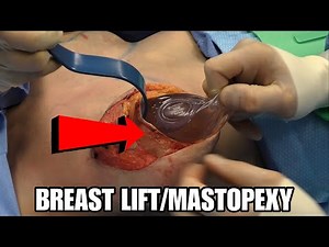 Breast lift/Mastopexy surgery performed by Dr Mark Jabor