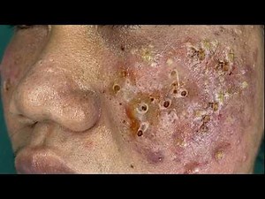 Viral Pimple Popping Compilation 2026 – Most Satisfying Blackhead & Acne Extractions l 4K video