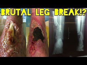 DEADLIEST SKATEBOARDING FAILS BALLS BLEEDING!MOST SEVERE SKATING FAILS!!MOST SAVAGE SKATING FAILS#38