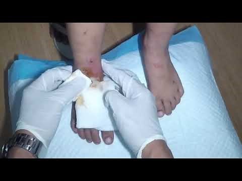 Draining of Pus (Abscess ) In Little Girl's Infected Foot