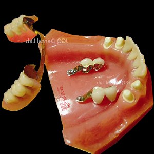 [Hot Item] Competitive Price Partial Precision Attachment Teeth Dental Dentures Framework for Unilateral and Bilateral Free End Dentures