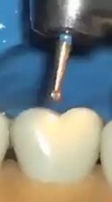 40K views · 149 reactions | Molar Crown Preparation!!! | Dental Videos | Facebook