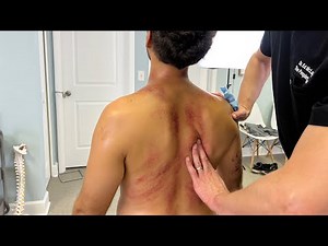 Digging Into Subscapularis 😣 OUCH! Man Can't Believe The Relief He Feels After *Cracks* & Massage