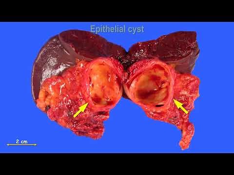 Spleen 2/5: Cystic lesions