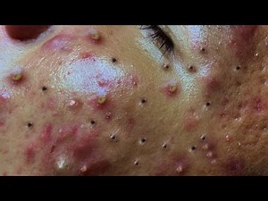 Most Satisfying Pimple Pops Ever!