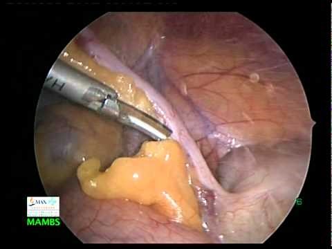 Laparoscopic surgery - Appendicectomy at Max Hospital