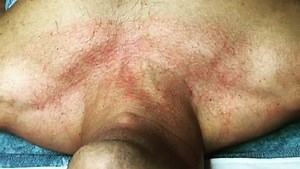 WHAT IS THE PLASMATIC EFFECT? It means that your capillaries have...