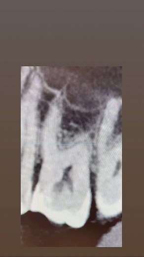 3K views | “What is causing my sensitivity to hot and cold liquids ?”...