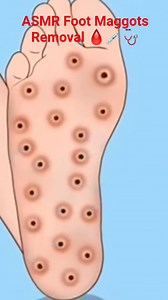 20K views · 88 reactions | #video ASMR Foot Maggots Removal 喝喙 | #reels #3danimation #satisfying #animation #trending #shorts | Akhilesh Yadav | Facebook