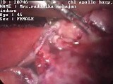 Laparoscopic salpingectomy - female • Video • MEDtube.net