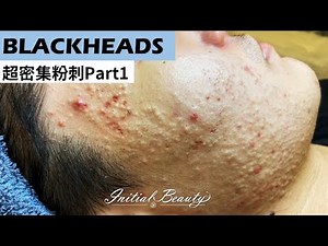 超密集粉刺part1( blackheads ) - Taiwan Tainan台南清粉刺最乾淨