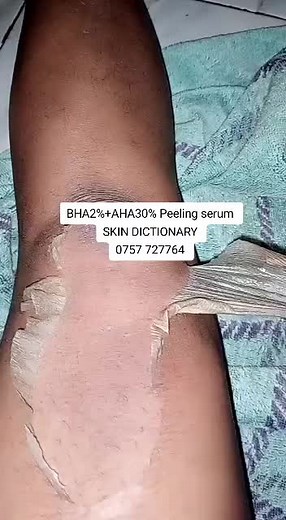 #chemicalpeelexperts #chemicalpeelingmethod #chemicalpeelingtreatment #chemicalpeeling #blacksoapmagic #skin_dictionary #darmatology #skin_dictionary #skindictionary #skindictionary #alienskin #alienskinug @BIGTRIL #@ALIEN SKIN ADDICT @DIGITAL ADVERTS LTD APP AFRICA @LaikaMusic @AlienskinUg BackUp @ALIEN SKIN ADDICT