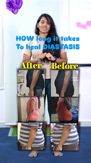 How do i address Diastasis Recti for my clients for better results I generally assess it in two types. When right muscles are targeted, results will be achieved soon ✅Looking to join my DR correction program for August batch.. DM or WhatsApp us on 7904136588 to enroll #fitkannamma #diastasisrecti #diastaseabdominal #weightlosstransformation #hernia #hernias #prolapse #soulfitstudio_fitkannamma | Fitkannamma