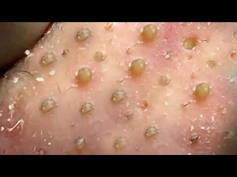 Relax Every Day With Loan Nguyen Spa | Acne Treatment Pimple Popping #27