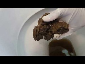 What Does It Mean When You Have Black Stool