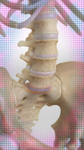 Ease lower back pain with AxiaLIF. Imagine easing your lower back pain with just a small incision on your butt and a screw in your sacrum. #backpain #backpainrelief #backpaintreatment #lowerbackpain #spine #3danimationsurgery #medicaleducation #medicalanimation #medicaldevices | Viz Medical