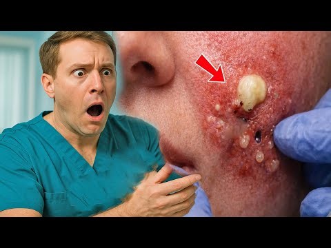 She Went to a Spa for Acne Treatment — What Doctors Found in Her Blood Was Shocking