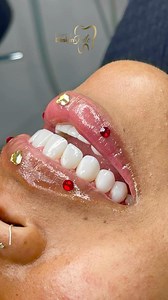 3.8K views · 16 reactions | 100% Porcelain  ✉ DM us for more info or ☎ call 786-452-1922 to request an appointment 11980 SW 8th st. Suite 1 Miami, FL 33184 | Dental Design Smile | Facebook