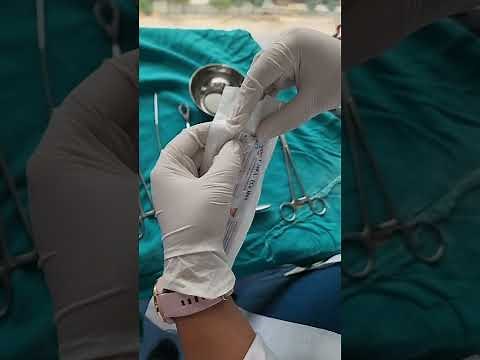 Insertion of an IUCD