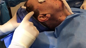 Facelift and Neck Lift Incisions