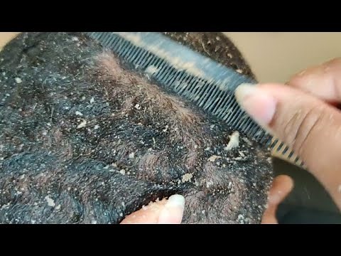 Popping Flakes | Dandruff Scratching