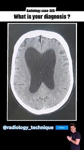 29K views · 124 reactions | Radiology case-328 H/0 40 year old patient presented chronic headache and vertigo.. What is your diagnosis ? | Diwakar Patel | Facebook