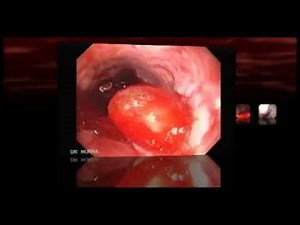 Esophagogastric Varices