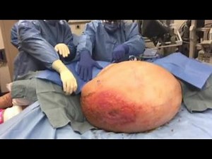 Surgeons remove 140-pound tumor from 71-year-old grandmother