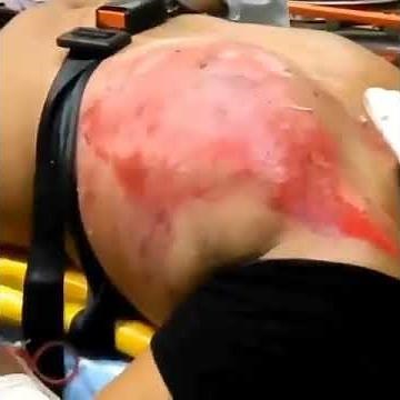 Flail Chest - Paradoxical Respiration