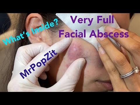 Very large facial abscess. So full and under pressure see the drainage and instant relief.