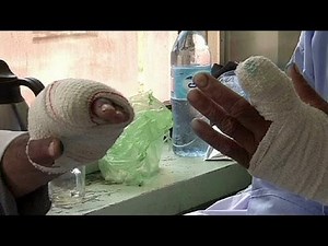 Megcsonkított szavazók Afganisztánban